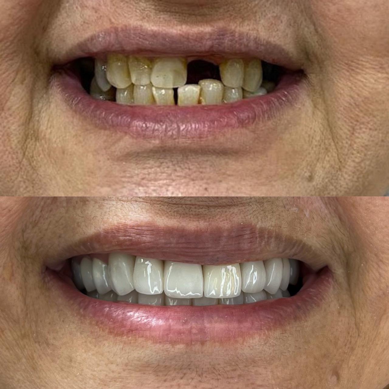 Boca5